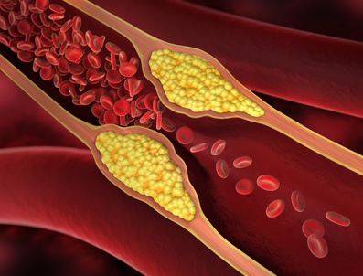 Arteriosklerose