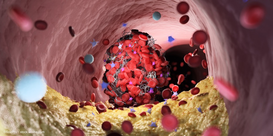 Blutgerinnungsstörung: Was Sie über Thrombose wissen sollten